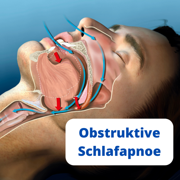  Obstruktives Schlafapnoe Syndrom OSAS SOLO Zahnarztpraxis Leipzig